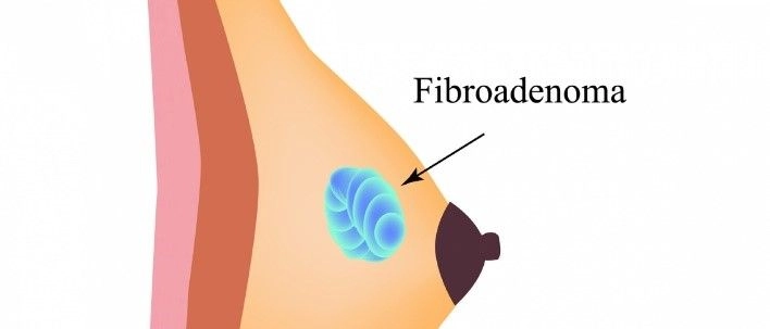 Fibroadenoma de mama Debo preocuparme 2