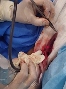 Labioplastía Estética Funcional con Láser CO2 5 Labioplastia con Laser CO2 por la Dra. Milagros Chiang