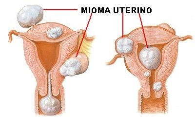 ¿Cuáles son los factores de riesgo para tener miomas uterinos? 3 Sintomas mioma uterino