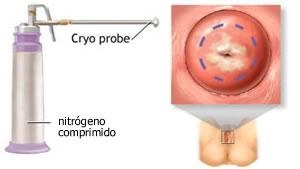 Crioterapia de Cervix Uterino 3 crioterapia cuello uterino