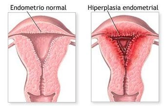 ¿Qué es la hiperplasia endometrial? ¿Es grave? 3 hiperplasia