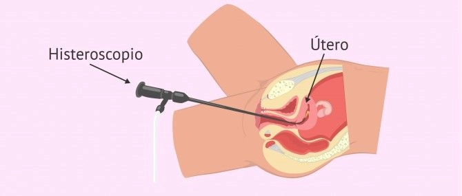 Pruebas de Fertilidad en la mujer ¿Cuáles son, como realizarlas y precios? 8 histeroscopio