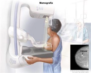 Dolor de senos o mamas ¿Cuándo preocuparse? 4 mamografia