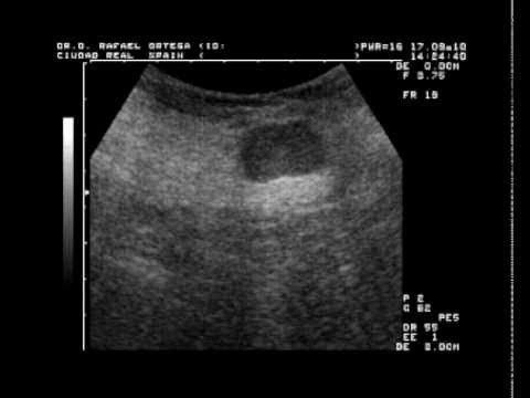 mamografia2