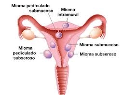 ¿Cuáles son los factores de riesgo para tener miomas uterinos? 4 miomas