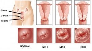 Cómo me puedo contagiar del virus de papiloma humano 6 papiloma4