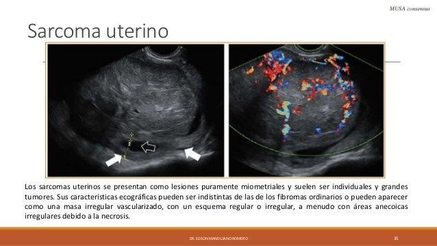 sarcoma uterino