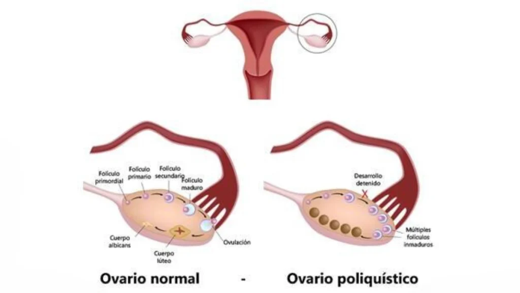 Como entender el Síndrome de Ovarios Poliquísticos 7 Como entender el Síndrome de Ovarios Poliquísticos