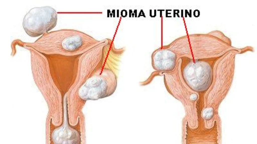 Cuales son los factores de riesgo para tener miomas uterinos