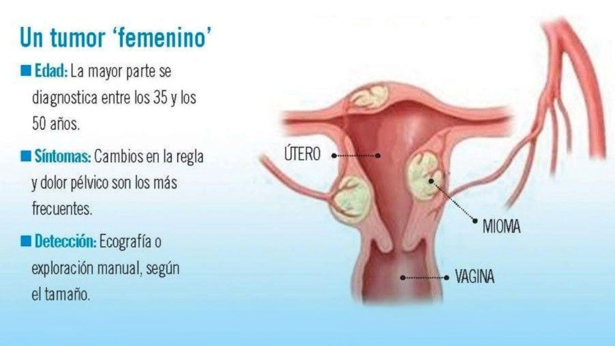 Existe una relacion entre mioma y generar con los anos un cancer de utero