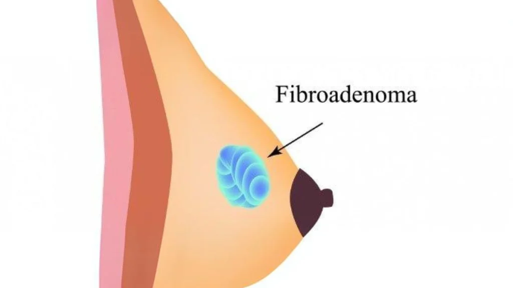 Fibroadenoma de mama ¿Debo preocuparme? 5 Fibroadenoma de mama ¿Debo preocuparme?