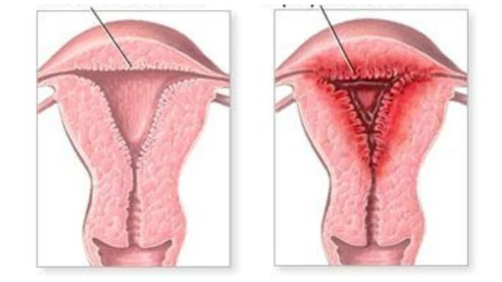 ¿Qué es la hiperplasia endometrial? ¿Es grave?