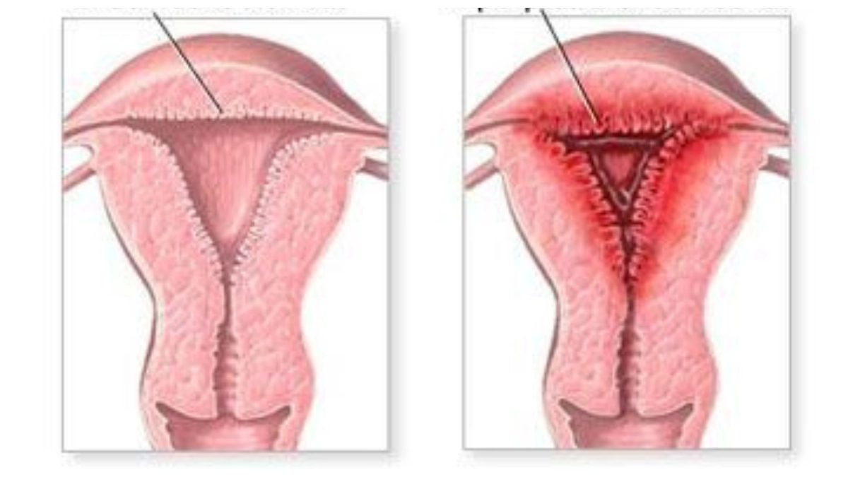 ¿Qué es la hiperplasia endometrial? ¿Es grave? 2 ¿Que es la hiperplasia endometrial ¿Es grave